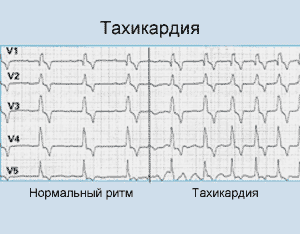 Тахикардия - причины, признаки, симптомы и лечение