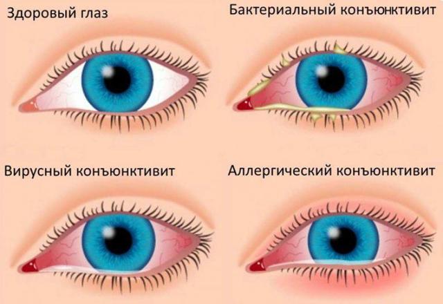 Тобрекс глазные капли - инструкция, цена, отзывы и аналоги