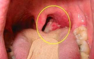 Рак гортани: Признаки, Причины, Симптомы рак горла, Лечение