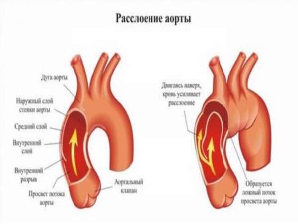 Расширение восходящего отдела аорты сердца