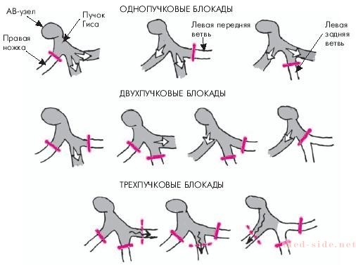 Блокады сердца на экг - Всё о сердце
