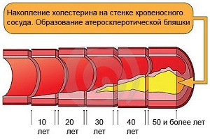 Анализы при стенокардии - общий анализ крови, холестерин, тропонины