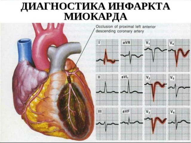 Классификация инфаркта миокарда: основные виды, формы и стадии
