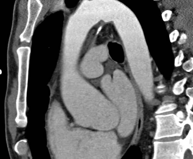 Аорта развернута что это значит. Аорта уплотнена и развернута что это