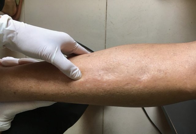 Отеки ног при сердечной недостаточности