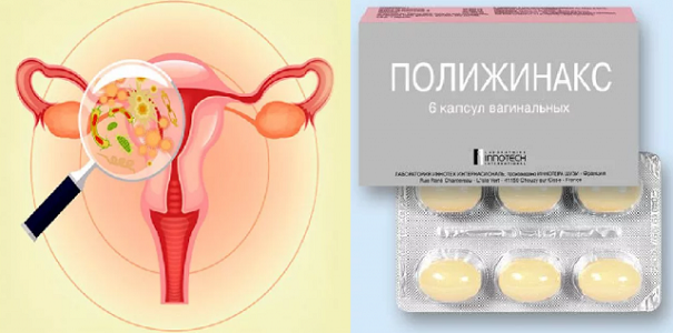 Кольпит - симптомы и лечение у женщин по видам, препараты, свечи