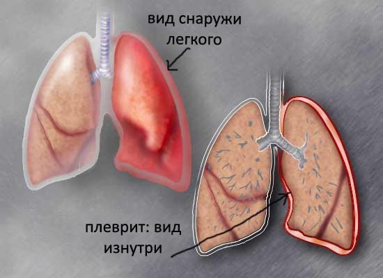 Плеврит легких, симптомы и лечение заболевания