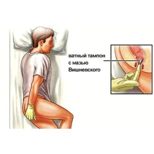 Как применять мазь вишневского при геморрое — Сайт о геморрое