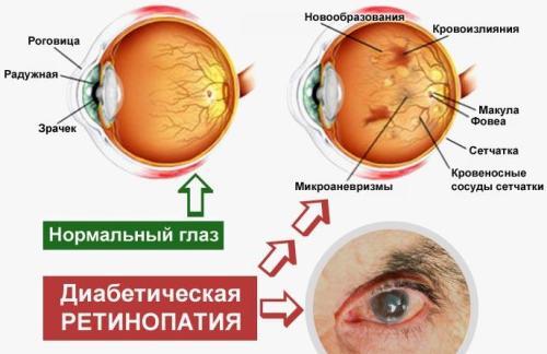 Диабетическая ангиопатия нижних конечностей: лечение сосудов при сахарном диабете, симптомы