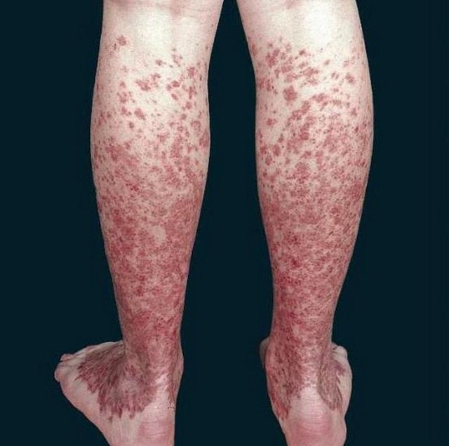 Системный васкулит мкб. Код по мкб системный васкулит