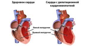 Заболевание бычье сердце