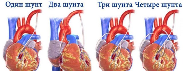 Коронарное шунтирование сосудов сердца - операция