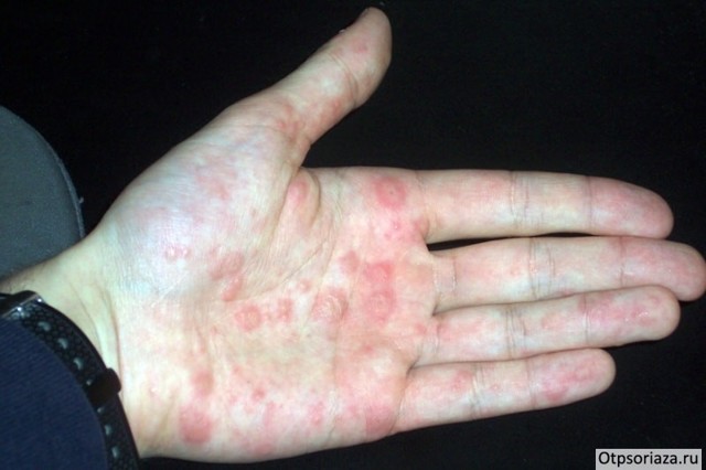 Лечение псориаз на руках - фото, симптомы, виды псориаза на руках