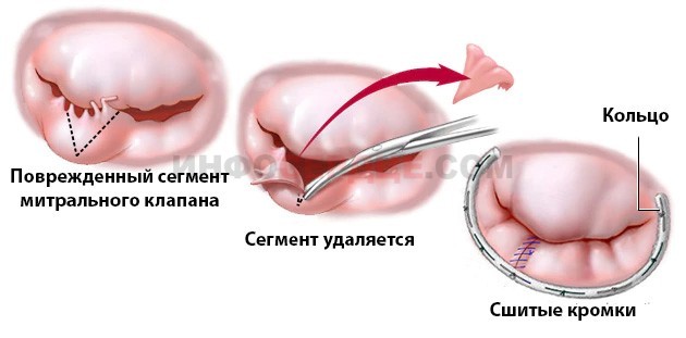 Регургитация митрального клапана