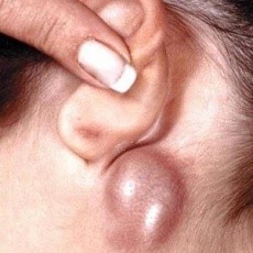 Особенности протекания и лечения миелоидного лейкоза