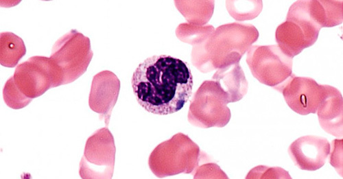 Если палочкоядерные нейтрофилы 0 у взрослого – о чем это говорит. Почему у ребенка повышены сегментоядерные и палочкоядерные нейтрофилы: причины высоких показателей в анализе крови