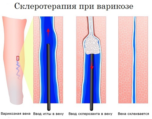 Дилатация вен малого таза - Варикоз