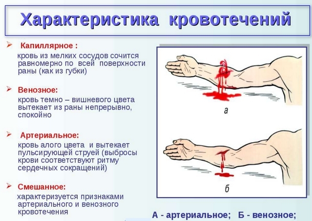 Пальцевое прижатие артерий при кровотечениях: точки и места прижатия