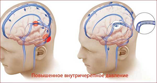 Синусовая брадикардия сердца – лечение народными средствами и чем опасна брадикардия?