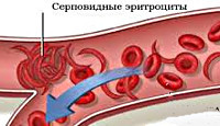 Серповидноклеточная анемия и типы ее наследования.