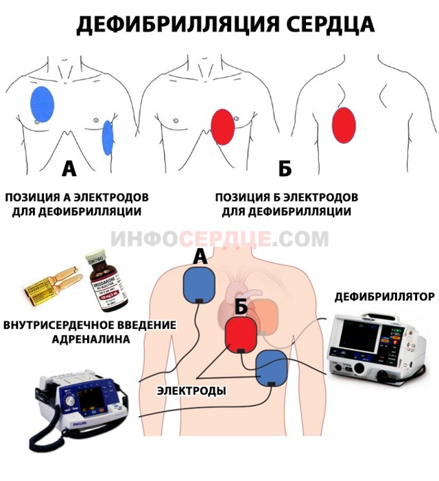Первая помощь при острой сосудистой недостаточности