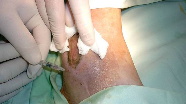 Трофическая язва - причины, симптомы, лечение, профилактика