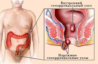 Как вправить геморроидальный узел самостоятельно пошаговая инструкция
