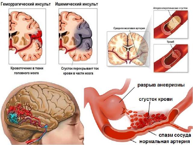Микроинсульт – симптомы и последствия, признаки, лечение, или Берегите здоровье смолоду