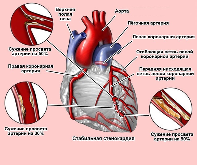Самопомощь и неотложная помощь при стенокардии