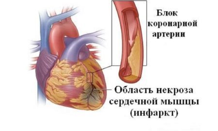 Донорство и гипертония — Давление и всё о нём