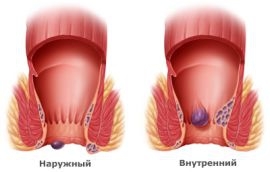 Геморрой у детей: причины, симптомы и лечение