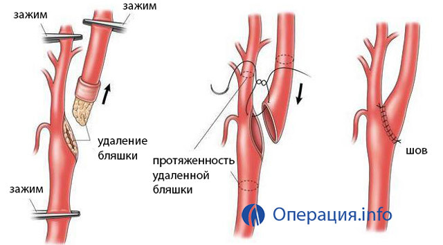 Операция на сонной артерии при атеросклерозе