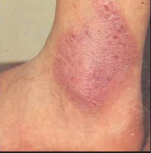 Нейродермит у взрослых и детей: симптомы (фото), лечение