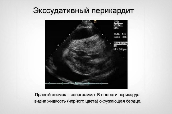 Эхо КГ сердца что это такое, как делают