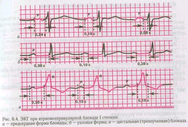 Ав блокада 1 степени лечение - Всё о сердце