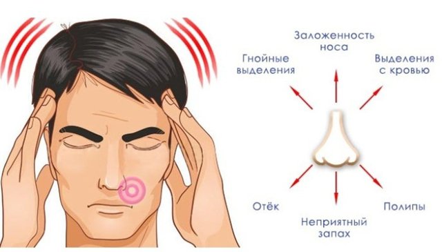 Острый гайморит - симптомы и лечение, прогноз