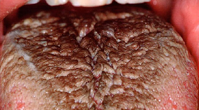 Коричневый налет на языке