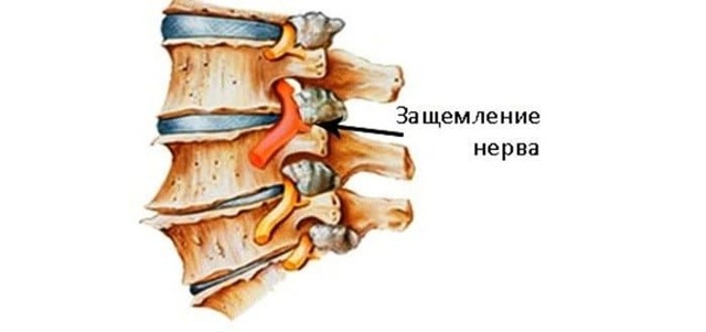 Защемление шейной артерии: причины, симптомы и способы лечения