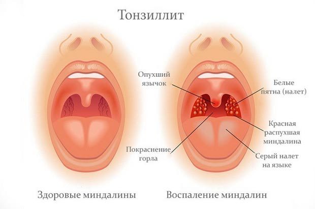 Тонзиллит: виды, фото, лечение и симптомы