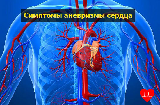 Аневризма сердца - Боль в Сердце