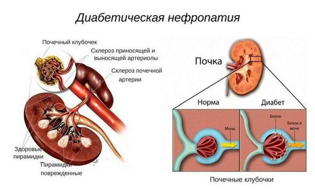Сахарный диабет и почки, осложнения на почти от СД