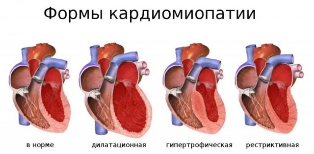 Кардиомиопатия: что это такое, виды, симптомы и лечение