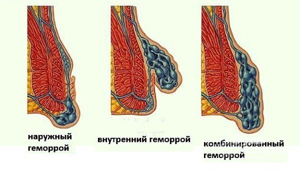 Геморрой при беременности - признаки, симптомы, причины и лечение