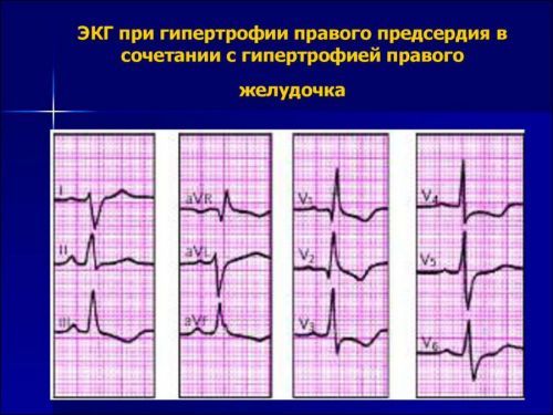ЭКГ. Гипертрофия правого желудочка. Характерные признаки гипертрофии правого желудочка на ЭКГ