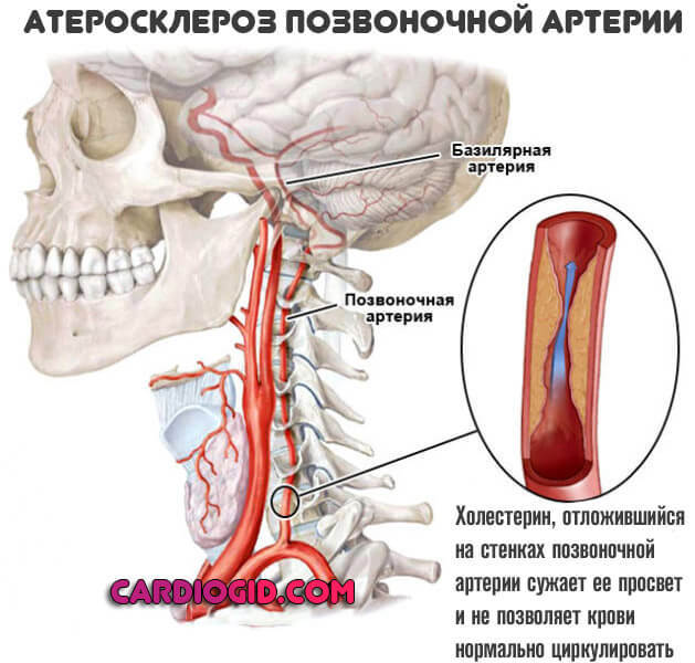 Атеросклероз сосудов головного мозга - лечение, симптомы