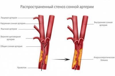 Нестенозирующий атеросклероз артерий