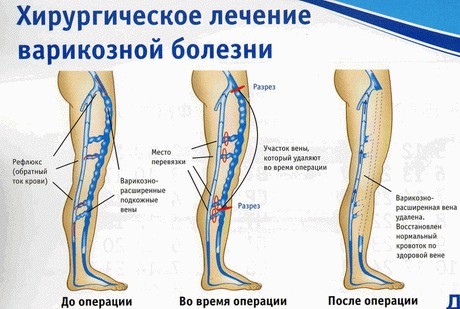 Венозная недостаточность симптомы признаки - Варикоз
