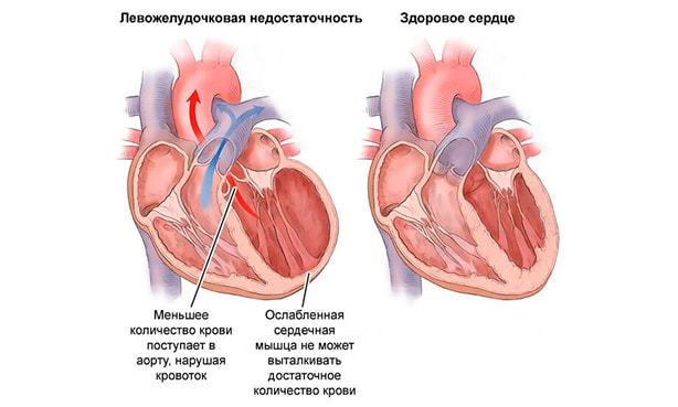 Кашель при сердечной недостаточности - Гипертонии нет