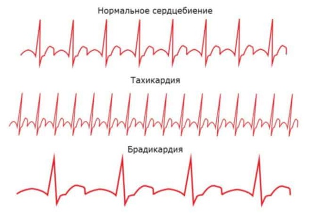 Брадикардия симптомы и лечение, какие таблетки принимать?
