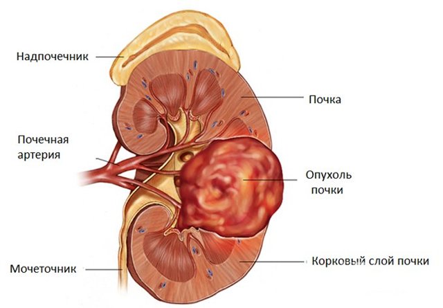 Кровь в моче: причины у женщин